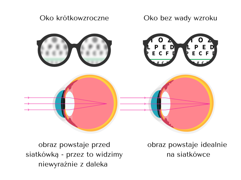 Krótkowzroczność - powstawanie obrazu na siatkówce